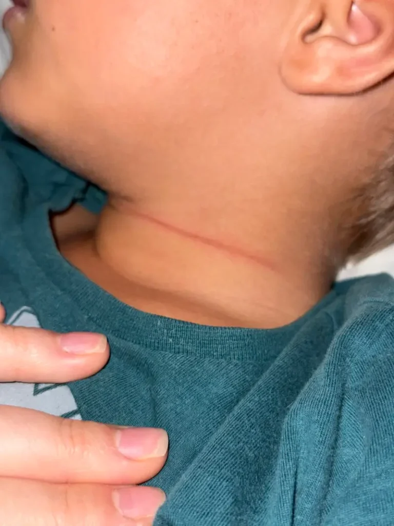 Criança de 4 anos tem pescoço cortado por linha com cerol enquanto brincava na rua no Piauí